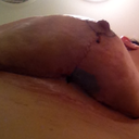 Close up of skin hematoma under right breast.