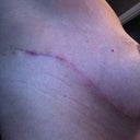 rev scar 9 wks post