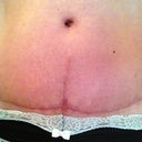 Full scar close up at 12 weeks. Hate the T scar!  Oh well.