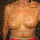 Well here are some results so far.  As you can see I'm still somewhat lopsided but I am so glad he did not do a lift.