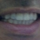Shown with Invisalign (6 of 13) Aug 20/12