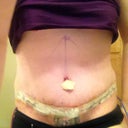 1dpo swollen but wow i cant believe this is me and i wonder what it will look like when the swelling goes down