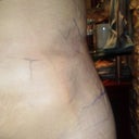 Left side without garment..