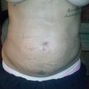 Day 10 see the lil lump.  uggggg