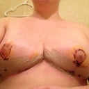 6 days post op