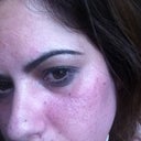 11 days in , really harsh light, still textural problems but you can see the type of scarring I have