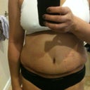 3 weeks PO, super swollen!