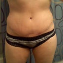 6 weeks post op