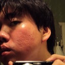 May 28, 2012 - One month after procedure

This is the right side of my face (reflected in a mirror) given the worst possible lighting.