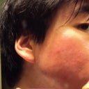 May 28, 2012 - One month after procedure

This is the left side of my face (reflected in a mirror) given the worst possible lighting.