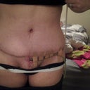 two weeks post-op