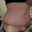 two weeks post op scar