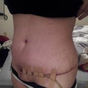 two weeks post op