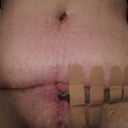 two weeks post op