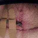 two weeks post op closeup of Mons Pubis and drain
