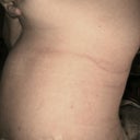 side view PO 10 days, still really swollen