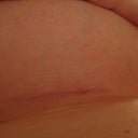 my scar (infra-mammary)