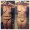 4 months post op. Gained a little weight.