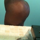 butt close view 2 -  weeks post op