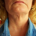 Update....10 months. I have my head completely straight towards the camera. I am not flexing any muscle in my neck. This loose skin and bands showing through the skin.