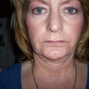 Update.....10 months post op. You can see the right side of my face is flat with the bulk sagging in the jowl area. I tipped my head slightly down to bring out the rings around my neck. You can see that the right side of my neck was pulled up more.