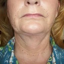 Lower right side of face is loose and fuller. Dr. only willing to lipo to reduce fullness