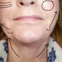 Left side of face pulled too much. Right side of face still hanging