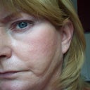 This is a much better picture of the sweep mark.  I only have this on the left side of my face.