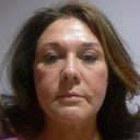 49 Year Old Woman Has Mini Facelift