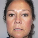 49 Year Old Woman Has Mini Facelift