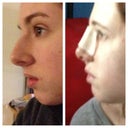 Before surgery and day after