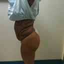 SIDE - before lipo - day 4