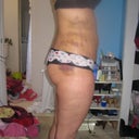 After lipo