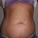 Pre op belly