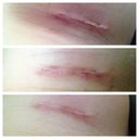 Left incision. 11,14 and 21 days post