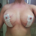 Frontal VERY swollen view. Will get much better in time.