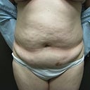 This is my abdomen before the abdominoplasty