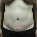 After the abdomen surgery