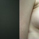 This is not my photo, I deleted mine, however these look pretty close to my results, except the before should be much more drooped.