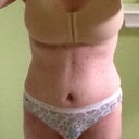 Tomorrow will be 4 weeks PO.  Swollen from doing too much.