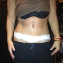 9 days after surgery