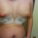 day 1 post op