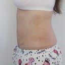 Left Side - 20 days post op