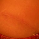 Close up of scar 1 year