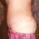 One side.  Of course I still have my stretch marks but no one sees those when I am dressed