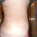 My TT was done on Oct 21, 2011 it has been almost 13 months.  Everything healed great and you can see the scar is very light and thin.