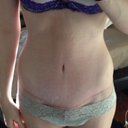Incision at 15 weeks :) :) :) getting lighter!!!