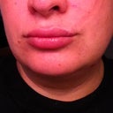 Day 3 post procedure, noticed the most amount of swelling today.
