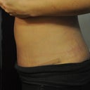 day 12 po really hope there is a lot of swelling lol