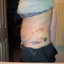 8days  Look at the difference in bruising from day 5 to day 8